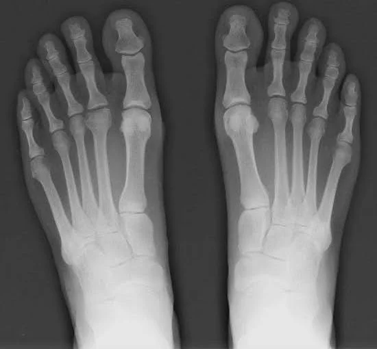 Hallux valgus et chaussures: Comprendre les problèmatiques -  - Chausse toi