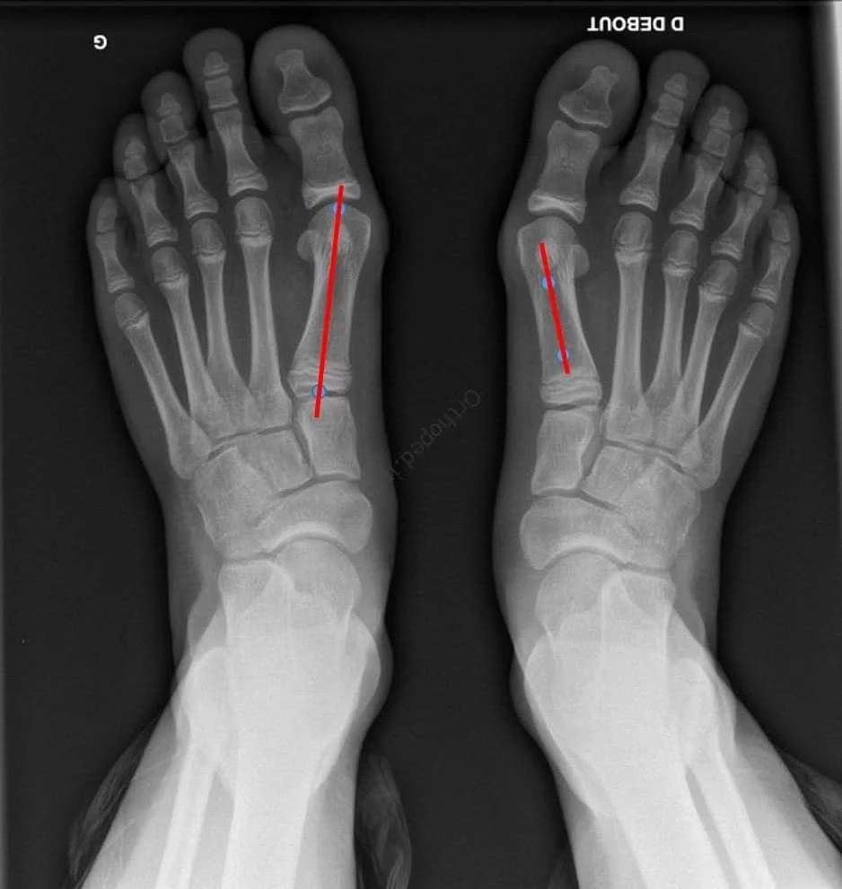 Hallux valgus et chaussures: Comprendre les problèmatiques -  - Chausse toi
