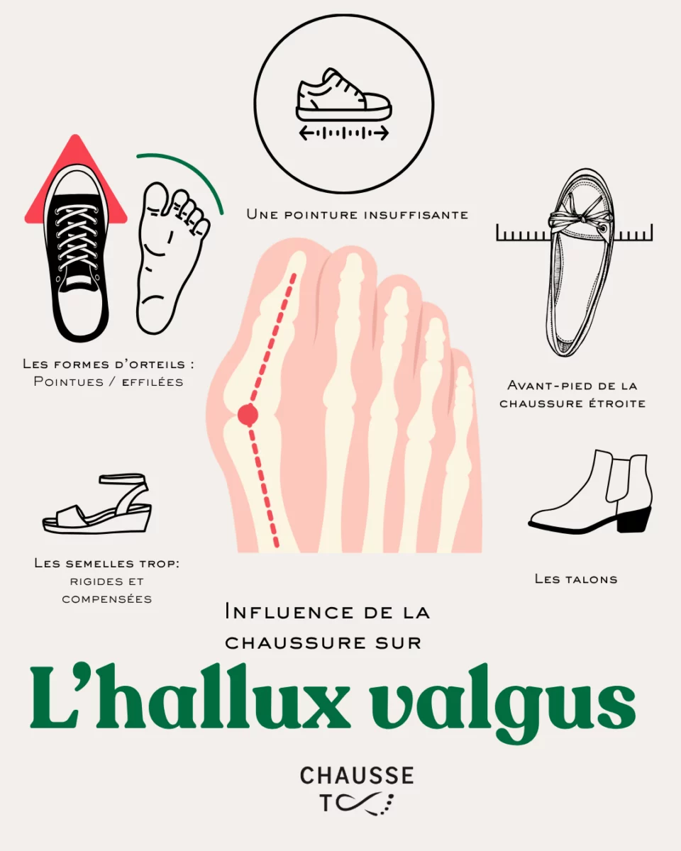 Hallux valgus et chaussures: Comprendre les problèmatiques -  - Chausse toi