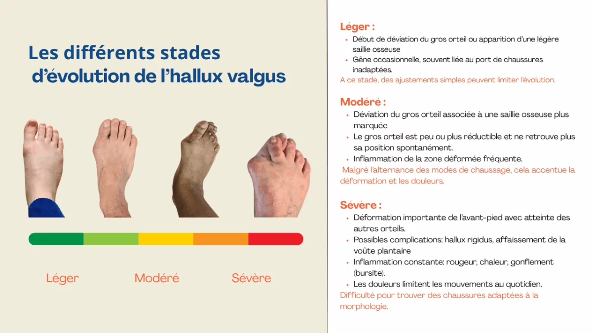 Hallux valgus et chaussures: Comprendre les problèmatiques -  - Chausse toi